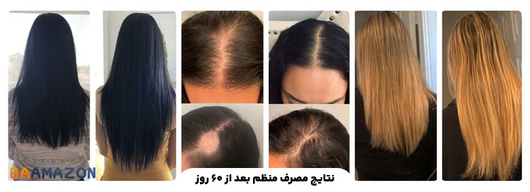 درمان ریزش مو با قرص هیرتامین